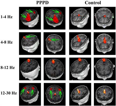 Altered Neuromagnetic Activity in Persistent Postural-Perceptual Dizziness: A Multifrequency Magnetoencephalography Study